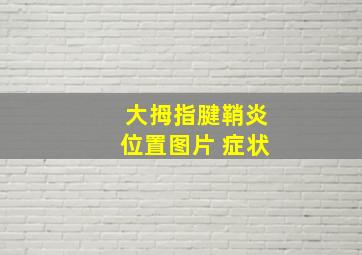 大拇指腱鞘炎位置图片 症状